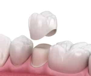 Dental Crowns Montgomery Pediatric Dentistry dentist in Princeton, NJ Dr. Christina Ciano Dr. Geena Russo Dr. Jammal